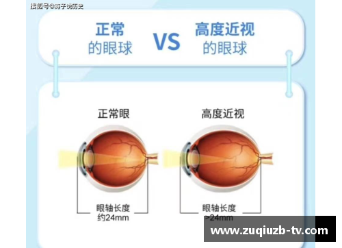 体育明星近视手术背后的故事与启示：眼睛健康与运动表现的关系探讨